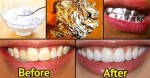 Tooth whitening methods
