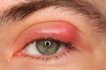 What do you know about Chalazion cysts?
