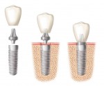 Cost of putting in a dental implant