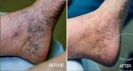 THE MOST EFFECTIVE NATURAL REMEDY FOR VARICOSE VEINS AND HEMORRHOIDS