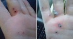 (PHOTO) Black Spots Appeared on Her Hand, and What Came Out of Them is More Than Disgusting!