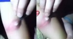 This Spooky Video Of A Girl Getting Her Blister Cut Open Is Weird And Bone-Shaking