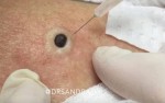 For Years She Thought It was Just a Mole. Then Her Doctor Informs Her It Isn’t. What She Yanks Out? Omg!