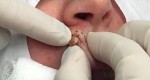 This Woman Squeezed Her Lip For A Year Until A Doctor Found This!