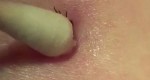 VIDEO: He Takes A Cotton Swab And Presses It Against His Skin. What He Yanks Out Of His Body? GROSS