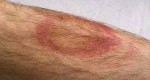 This Man Died Days After This Red Spot Showed Up. The Docs Freaked When Figured Out Why?
