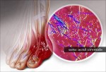 How To Quickly Remove Uric Acid Crystallization From Your Body To Prevent Gout And Joint Pain