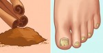 Here’s How Cinnamon Can Be Used To Treat Unsightly Toenail Fungus Naturally