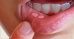 Canker Sores In The Mouth: Here Is How To Naturally Get Rid Of Them In A Matter Of Minutes Without Using Any Medicine