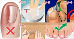 Amazing Way To Remove An Ingrown Toenail Without Surgery