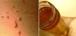 REMOVE FIBROMA OR SKIN WARTS VERY EASY