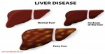 FATTY LIVER: CAUSES, SYMPTOMS AND NATURAL TREATMENTS