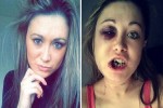 Woman Shares Her Wounded Pictures After Refusing To Sleep With Her Ex-Boyfriend