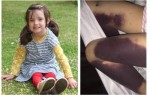 TERRIBLE BRUISES APPEARED ON 4-YEAR-OLD GIRL’S LEGS. DOCTORS DISCOVERED A SHOCKING REASON