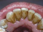 HOW TO REMOVE PLAQUE WITHOUT GOING TO THE DENTIST