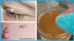 REMOVE FIBROMA OR SKIN WARTS VERY EASY! THE CHEAPEST AND THE MOST EFFECTIVE CURE EVERYONE HAS AT HOME!