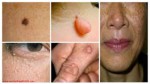 NATURAL WAYS TO PUT AN END TO MOLES, WARTS, BLACKHEADS, SKIN TAGS AND AGE SPOTS