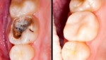 REMOVE CARIES AND CAVITIES IN JUST 4 STEPS!