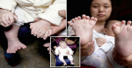 Parents Want Surgery For Boy Born With 31 Fingers And Toes!