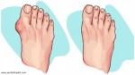 REDUCE BUNION SIZE WITH THESE 5 NATURAL REMEDIES!