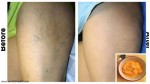 THE MOST EFFECTIVE NATURAL TREATMENT FOR VARICOSE VEINS!