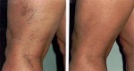 Amazing: Simple Tips to Get Rid of Spider Veins