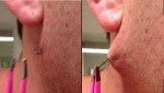 (VIDEO) MAN PULLS OUT THE WORLD’S LONGEST INGROWN HAIR FROM BLACKHEAD AND THEN…OMG!