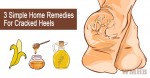 3 Simple Home Remedies For Cracked Heels