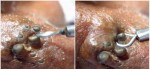 THIS MAN’S BLACKHEADS WERE POPPED OUT, SEE THE SHOCKING TRANSFORMATION AFTER!