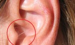 Having Crease in Your Ear Is A Warning Sign! What Does It Mean?