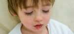 Why You Should Never Give Ibuprofen To A Child With Chickenpox