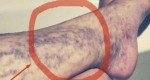 Everyone Has This Miracle Cure for Varicose Veins At Home, But Many People Don’t Know About It!