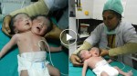 A baby in India was born with two heads! How is this possible? Unbelievable!