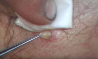 It Looks Like A Pimple On His Back. But What They Pulled Out, Got Bigger And Bigger (Video)