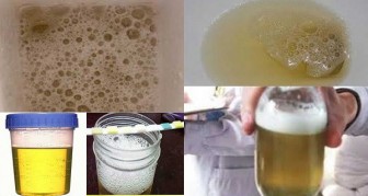 FOAMY URINE? YOU SHOULD PAY CLOSE ATTENTION TO THIS, IT COULD BE….
