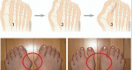 What Are Bunions? How Are They Caused And What Are The Natural Ways To Remove Them?