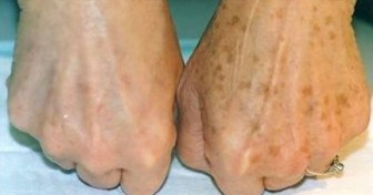 She Noticed Brown Spots On Her Hands, Then She Removed Them With This
