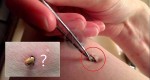 Watch: What This Woman Pulled Out From Her Leg Using Tweezers Is Shockingly Relieving