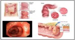 Simple Tips for Dealing with Ulcerative Colitis Flares