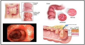 Simple Tips for Dealing with Ulcerative Colitis Flares