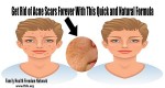 Get Rid of Acne Scars Forever With This Quick and Natural Formula