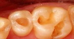 Healing Cavities From Home Is Actually Really Easy! (HOW-TO)