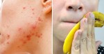 She Rubs a Banana Peel on Her Face and THIS Happens to Her Acne!
