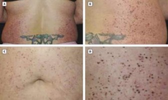 WHY DID THIS WOMAN SUDDENLY DEVELOP THOUSANDS OF MOLES ALL OVER HER BODY?