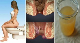 TREATING HEMORRHOIDS AT HOME: WITH ONE INGREDIENT FROM YOUR KITCHEN YOU WILL BE CURED IN 24 HOURS !