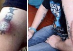 Photos: He Ignored This Bug Bite Until It Was Too Late. What Doctors Reveal To Him? Be Warned…