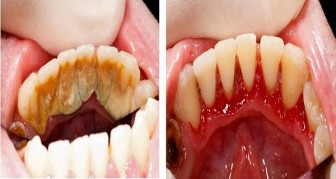 Be Your Own Dentist! Here are Tricks to Remove Tartar Buildup at Home
