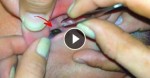 He Claims That His Right Ear Is Painful. What They Extracted From It Will Blow You Away