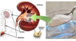 HOW TO REPAIR YOUR DAMAGED KIDNEY NATURALLY USING 1 TEASPOON OF BAKING SODA