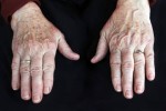 The First Symptoms Of Cancer Appear On The Hands